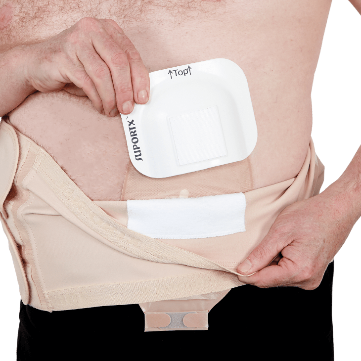 Suportx Shield Ostomy Belt With Easy Peel Fastening 15cm Box